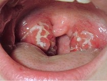 Bệnh lậu ở miệng biểu hiện như thế nào?